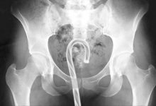 博狗扑克:2019年《老美往某穴插入的异物种类》统计 人们到底是多爱往洞里塞圣诞节装饰物啊-博狗扑克 蜗牛扑克 德州扑克跟我学