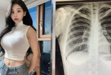 [网络美女]韩国「百万网红」不满被质疑整形…晒X光照自证清白：我没有动过手术-博狗扑克 蜗牛扑克 德州扑克跟我学