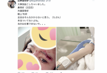 【EV扑克】鼻子骨折眼皮缝了15针！辻井ほのか(辻井穗乃果)重伤破相！-博狗扑克 蜗牛扑克 德州扑克跟我学