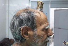 【EV扑克】印度男子头部长出牛角, 这是怎么回事如今怎样了-博狗扑克 蜗牛扑克 德州扑克跟我学