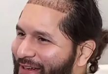 从八角笼到手术台：UFC名将豪尔赫·马斯维达尔赴土耳其植发，大发体育助力你的致富之路！-博狗扑克 蜗牛扑克 德州扑克跟我学